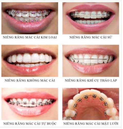 cac-loai-nieng-rang
