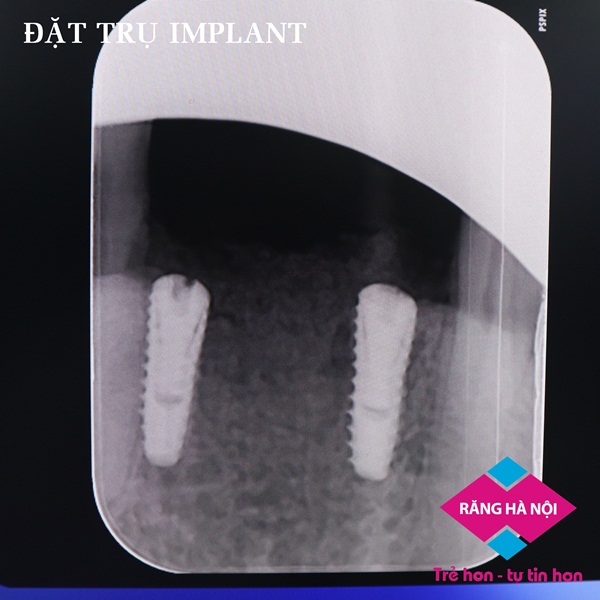 tru-implant