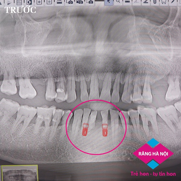 rang-implant