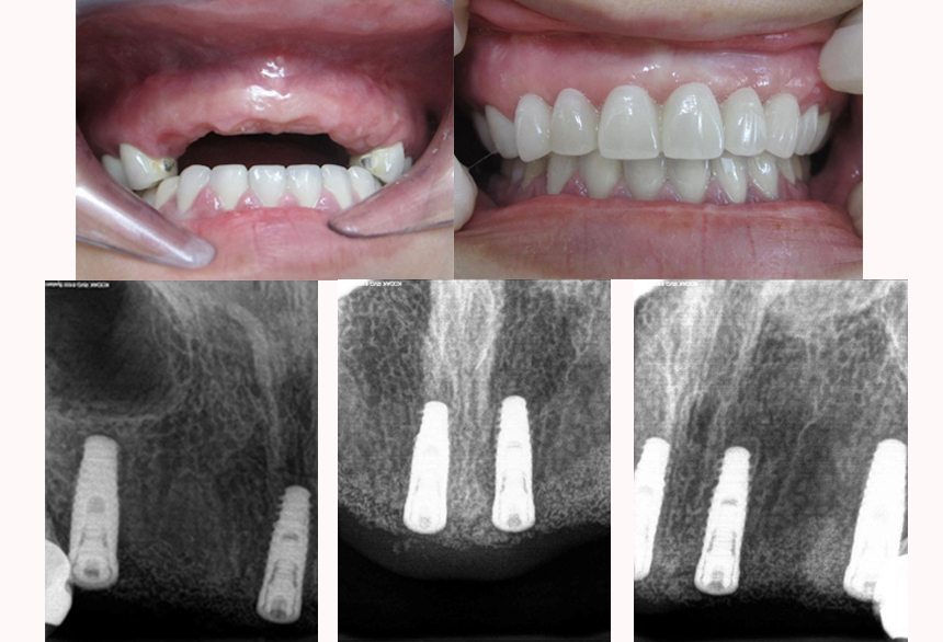 trong rang implant