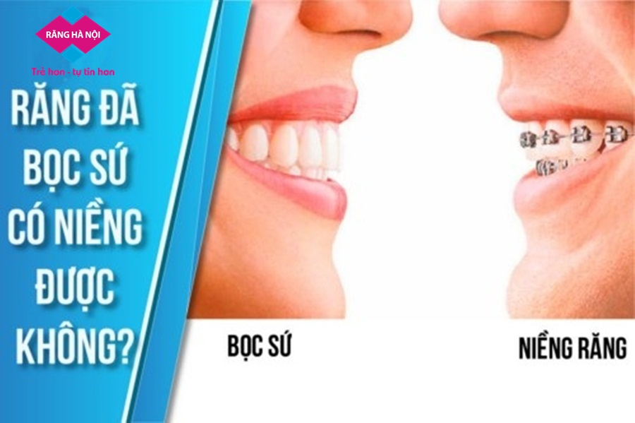 boc-rang-su-co-nieng-duoc-khong