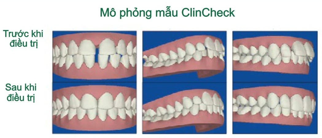 clincheck