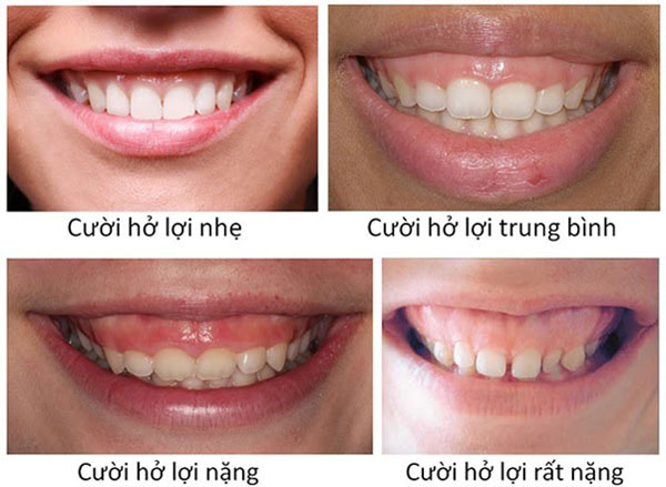cac-muc-do-cuoi-ho-loi