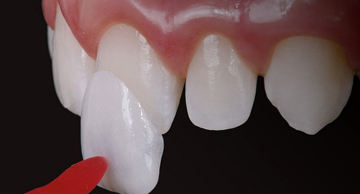 lam rang su veneer mat bao lau