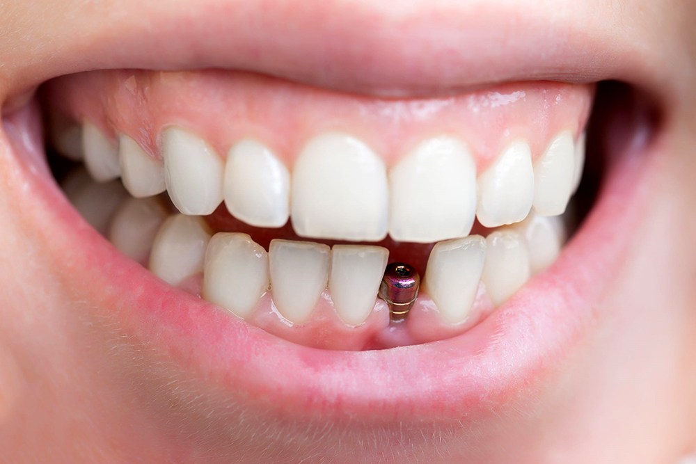 cay ghep implant de tranh tieu xuong