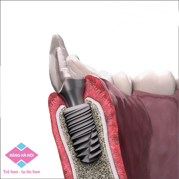 implant-phap