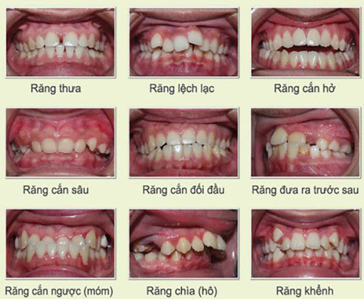 nhung-ai-nen-nieng-rang