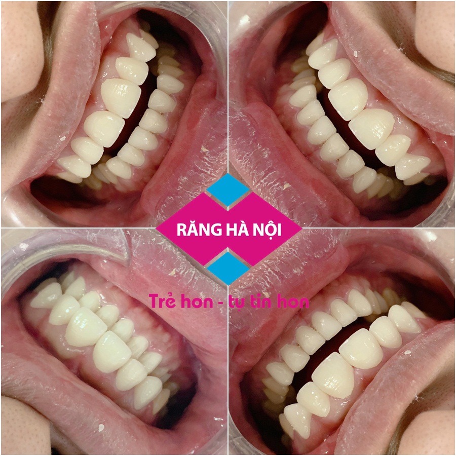 rang-su-tham-my