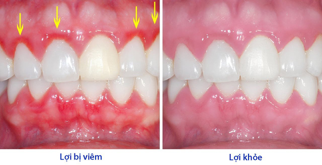 Viem loi
