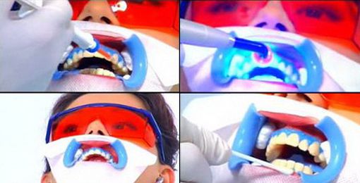 tay trang rang bang laser