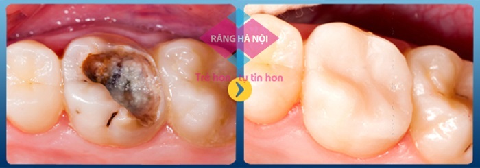 Hàn Răng