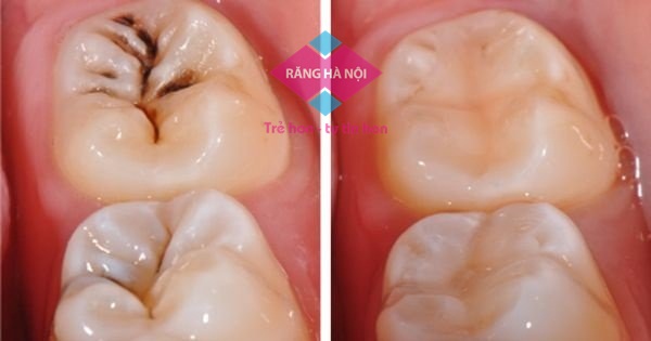 tram-rang-sau-bao-nhieu-tien
