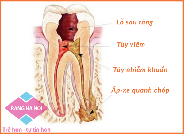 Viem tuy rang