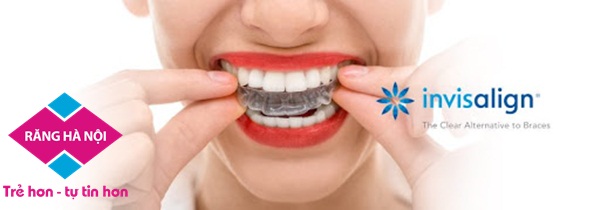 chinh nha invisalign1