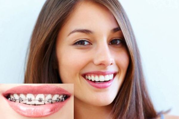 Chỉnh Nha Cố Định Một Hàm