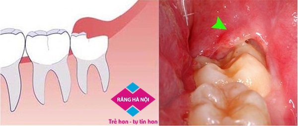 Cắt lợi trùm