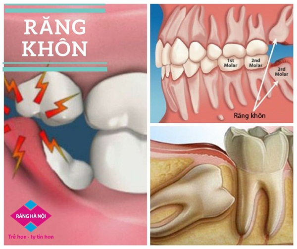 Nhổ răng khôn