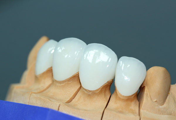 Răng sứ không kim loại Lava Esthetic