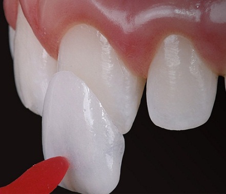 Dán sứ Veneer
