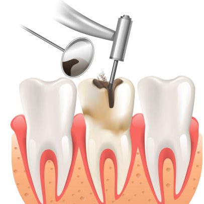 ĐIỀU TRỊ TỦY, HÀN RĂNG