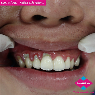 RĂNG HÀ NỘI TIẾP TỤC DỊCH VỤ LẤY CAO RĂNG