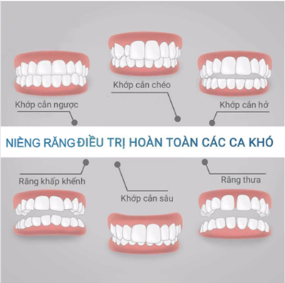 Niềng Răng Không Chỉ Là Đẹp