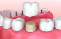 Địa Điểm Trồng Răng Sứ Thẩm Mỹ Chất Lượng