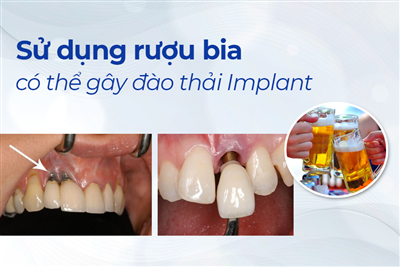 Uống Rượu, Bia Có Thể Gây Đào Thải Răng Implant?