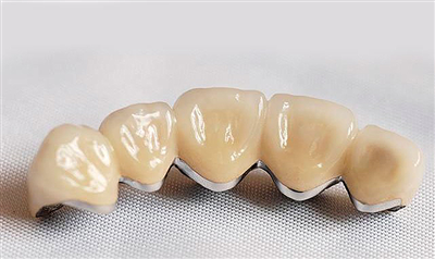 Trồng Răng Răng Sứ Titan - Cho Hàm Răng Sáng Và Nụ Cười Tươi!