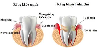 Nha Chu Là Gì? Nguyên Nhân Gây Bệnh?