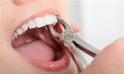 Niềng Răng Có Cần Nhổ Răng Không?