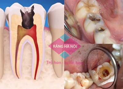 Điều trị tủy răng mất thời gian bao lâu?