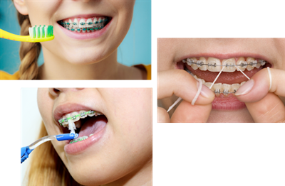 Chăm sóc, vệ sinh khi đeo mắc cài
