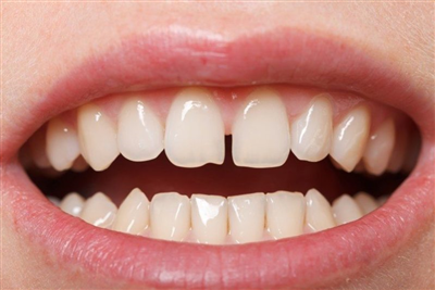 Làm Sao Để Khắc Phục Răng Thưa? Phương Pháp Phù Hợp Nhất Với Trường Hợp Răng Thưa