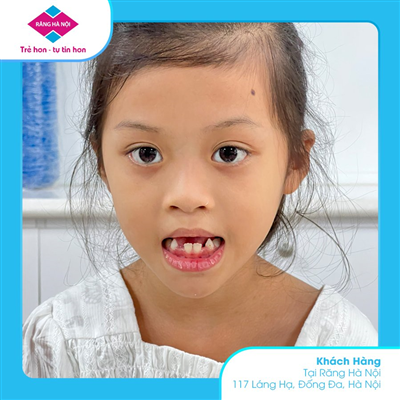 Răng Mọc Lệch Ảnh Hưởng Đến Sức Khỏe Răng Miệng Như Thế Nào?