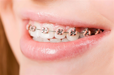 Tại Sao Phải Đeo Thun Tác Kẽ Khi Niềng Răng? RĂNG HÀ NỘI