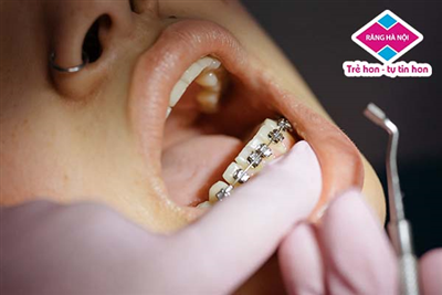 Tháo Niềng Răng Trước Thời Hạn Có Ảnh Hưởng Gì Không?