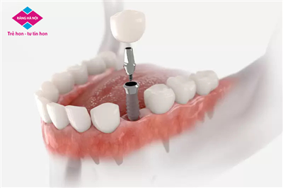 Trồng Răng Implant Giá Rẻ Có An Toàn Không ?
