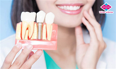 Lời Khuyên Sau Khi Cấy Ghép Implant Bệnh Nhân Cần Tuân Thủ