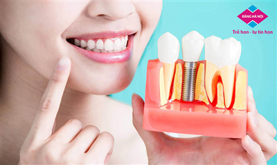 Chính Sách Và Chế Độ Bảo Hành Dịch Vụ Implant Tại Răng Hà Nội