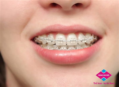 Độ Tuổi Nào Niềng Răng Là Phù Hợp?
