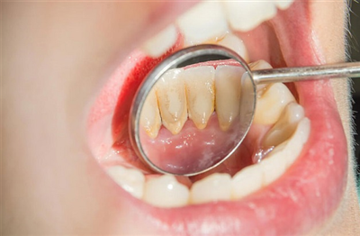 NÊN LẤY CAO RĂNG BAO LÂU MỘT LẦN?