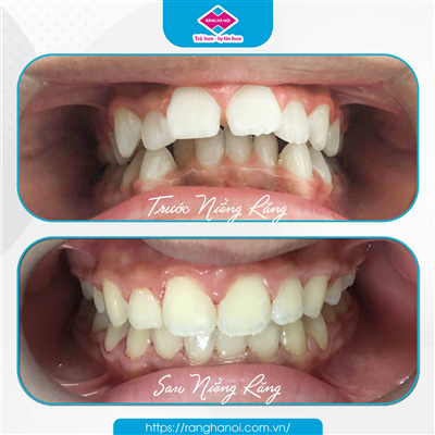 CÁCH NIỀNG RĂNG KHỚP CẮN SÂU HIỆU QUẢ NHẤT