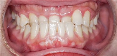 KHỚP CẮN NGƯỢC - NHỮNG ẢNH HƯỞNG KHÔNG TƯỞNG ĐẾN RĂNG CỦA CON