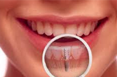 Trồng răng Implant All-in-4