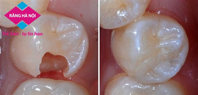 ĐIỀU TRỊ TỦY RĂNG