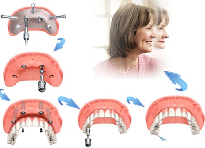 Các phương pháp trồng răng giả cố định