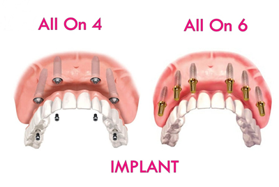 Implant All On 4 - All On 6