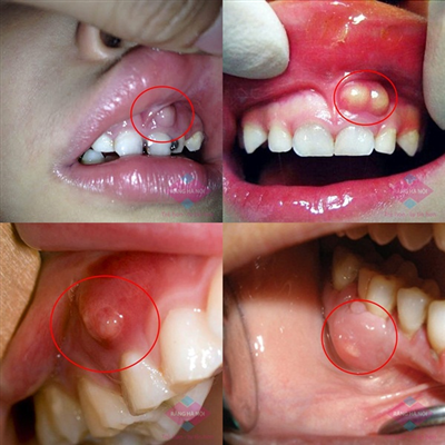 Áp xe răng - Bệnh thường gặp và biến chứng nguy hiểm
