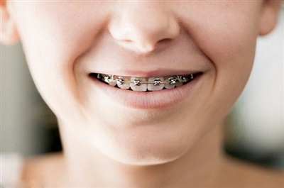 Trường hợp nào cần nhổ răng khi chỉnh nha?